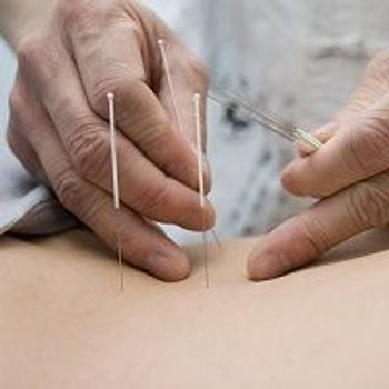 Warm Acupuncture May Relieve Symptoms in People With Fibromyalgia and Cold Sensitivity