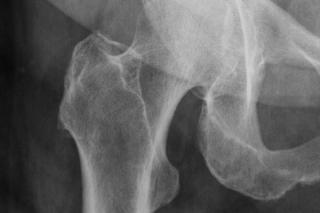 Controversies in Using Bisphosphonates for Treating Osteoporosis