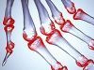 Static Electric Field Therapy by High Voltage Alternating Current Deemed Effective in Rheumatoid Arthritis