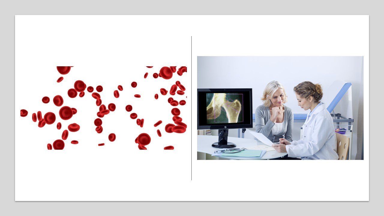 High Platelet Counts Associated With Osteopenia and Osteoporosis