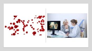 High Platelet Counts Associated With Osteopenia and Osteoporosis