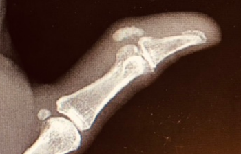 X-ray image of a patient's thumb. | Credit: Brady Pregerson, MD