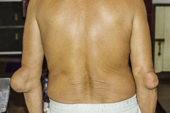 Osteoarthritis and gout may be more interrelated than previously thought