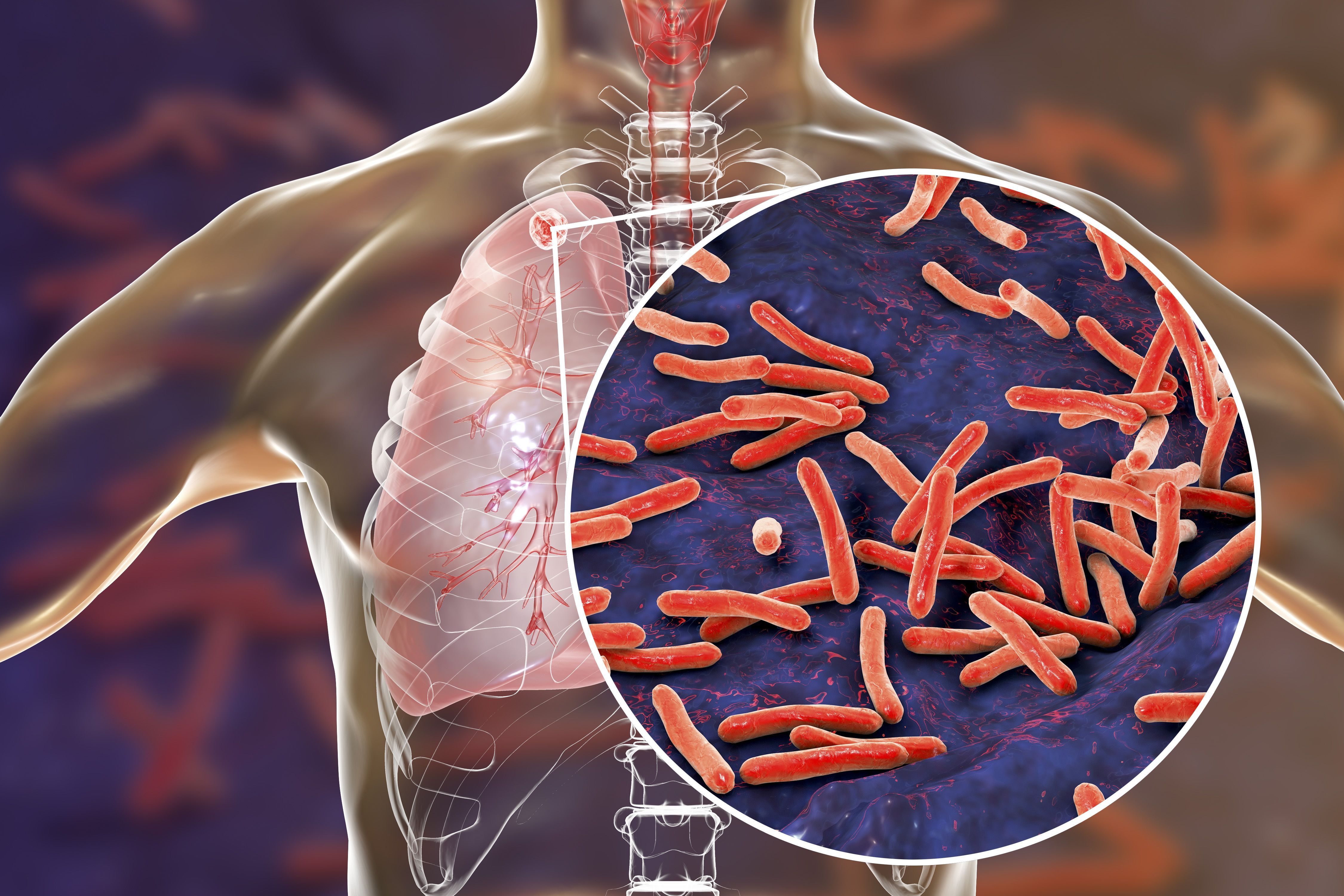 Secukinumab Not Associated With Tuberculosis