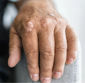 Secukinumab Demonstrates Long-Term Safety for Psoriasis and PsA