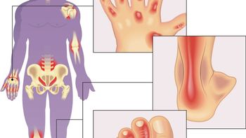 Apremilast Continues to Show Viability as Monotherapy