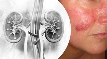 $50,000 economic burden of lupus nephritis