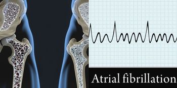 Examining the Risk Between Atrial Fibrillation and Bisphosphonates