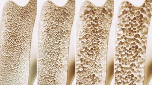 No Need to Routinely Screen Osteoporosis Patients for Coeliac Disease, celiac