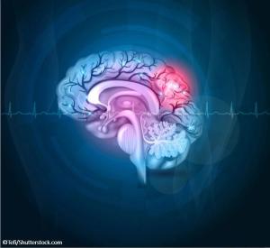 stroke patients, fracture risk, statins, osteoporosis