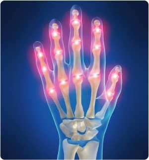 Underwater Inferential Current Therapy Improves Hand Psoriatic Arthritis
