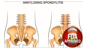 FDA Approves Ixekizumab for Ankylosing Spondylitis
