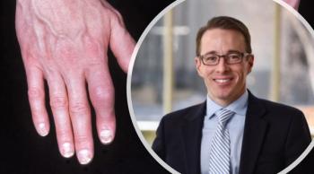 What pre-clinical signs should we look for to help diagnose psoriatic arthritis earlier?