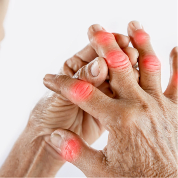 SEL-212 Advances Refractory Gout Outcomes with Prolonged Treatment | Image Credit: Adobe Stock