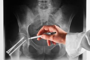 AAC, PVFx Help Predict Risk of Osteoporosis-Related, Other Fractures in Men