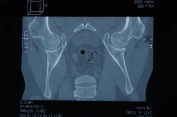 Methotrexate Lowers Immunogenicity to Adalimumab in Axial Spondyloarthritis