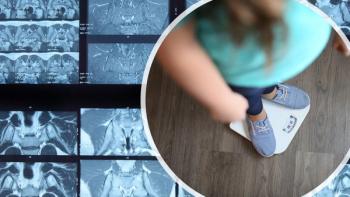 Q&A: BMI Link to Disease Activity in Axial Spondyloarthritis