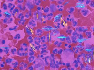 The Need to Revisit Treatment Approaches for Gout