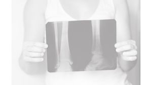 12 Recommendations for Osteoporosis Treatment