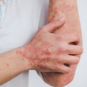Obesity, Nail Psoriasis May Increase Psoriatic Arthritis Risk in Children with Psoriasis