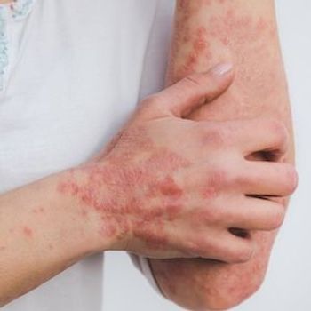 Obesity, Nail Psoriasis May Increase Psoriatic Arthritis Risk in Children with Psoriasis