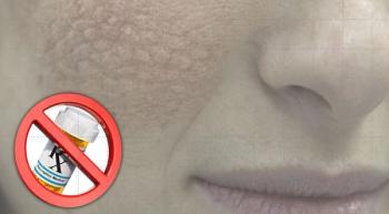 100 drugs that cause skin lupus