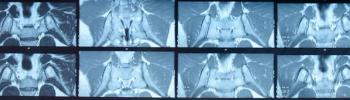 Long-Term TNFi Use in Axial Spondyloarthritis May Slow Radiographic Progression 