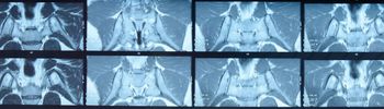 Long-Term TNFi Use in Axial Spondyloarthritis May Slow Radiographic Progression