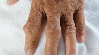 gout treatment gout drugs