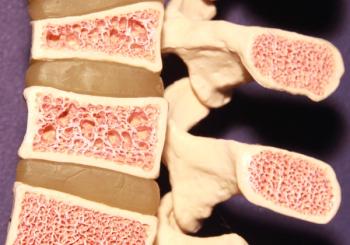 Delaying Denosumab Injections Increases Risk of Vertebral Fractures, Study Shows