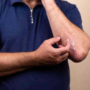 Study Finds Diagnostic Delay, Less Intensive Therapy for Psoriatic Arthritis | Image Credit: Adobe Stock