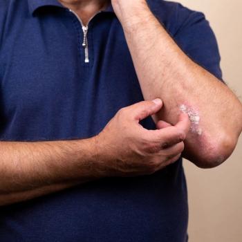 Study Finds Diagnostic Delay, Less Intensive Therapy for Psoriatic Arthritis | Image Credit: Adobe Stock