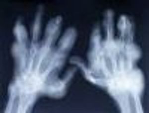 Cricoarytenoid Arthritis in Rheumatoid Arthritis Patients