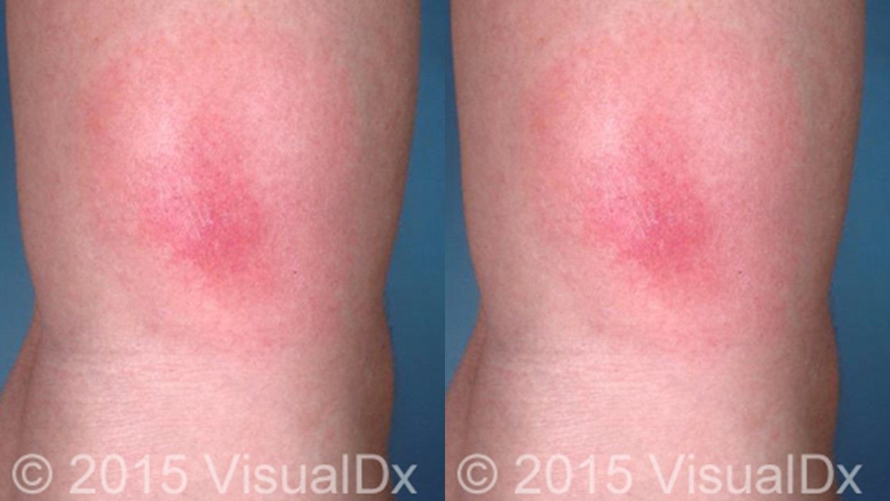 lyme disease rash