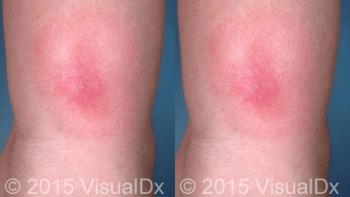 lyme disease rash