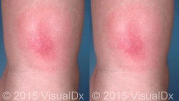 lyme disease rash