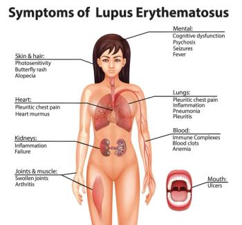 10 challenges in treating lupus symptoms.