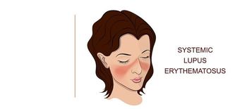 Type I Interferon Inhibition Could Benefit Systemic Lupus Erythematosus