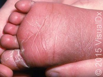 Image IQ: Infant with skin peeling