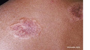 Image IQ: African American Woman with a Cough and Plaques on Her Back