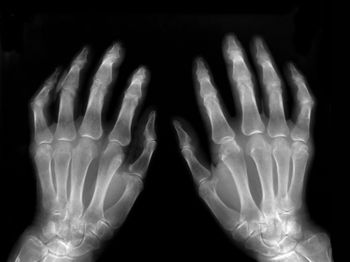 Fluorescence Optical Imaging Shows Potential in Rheumatoid Arthritis