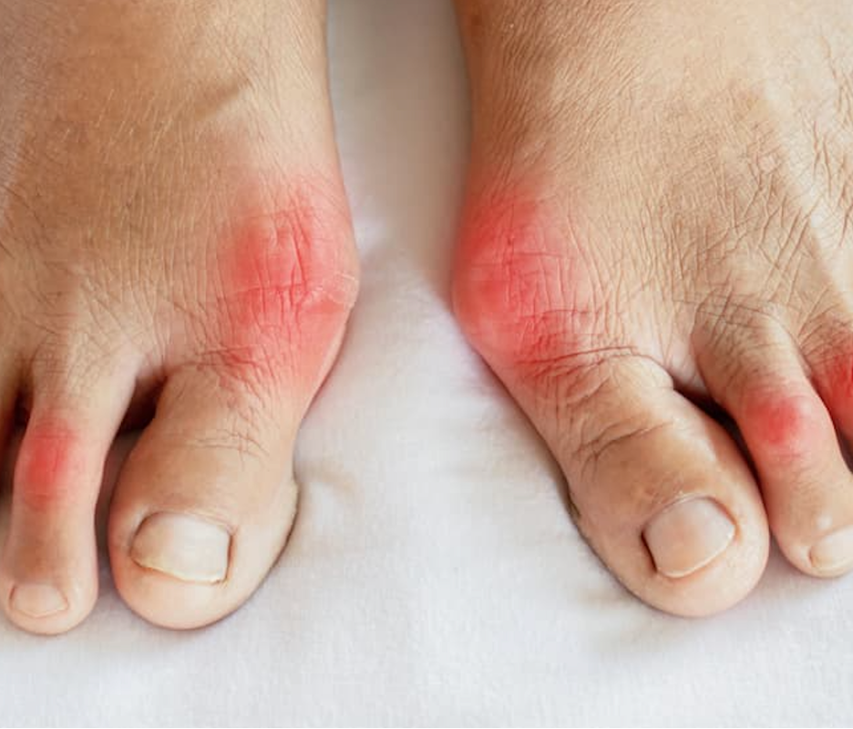 LAP May Predict Risk of Hyperuricemia and Gout 