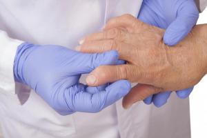 Phase 3 of Rheumatoid Arthritis Drug Meets Primary and Secondary Endpoints