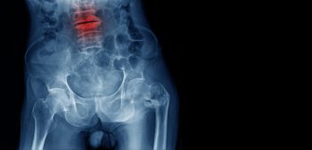 Oral Glucocorticoids and Fracture Risk in RA