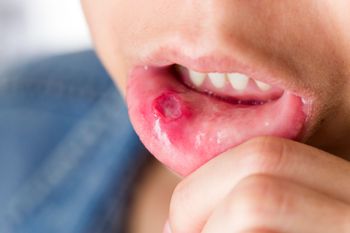 New Treatment Option for Behçet’s Disease