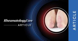 Psoriatic Arthritis Strongly Associated with Metabolic Syndrome and Components