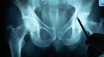total joint surgery osteoarthritis