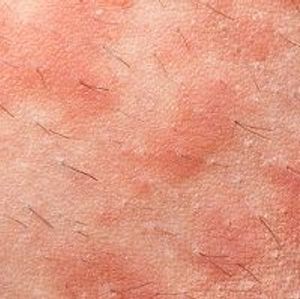 Testing Ustekinumab for Severe Atopic Dermatitis