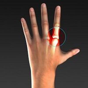 Upadacitinib Better than Adalimumab in Rheumatoid Arthritis