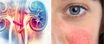 Phenotypes in SLE: Can They Predict Characteristic, Disease Outcomes and Treatment Needs?